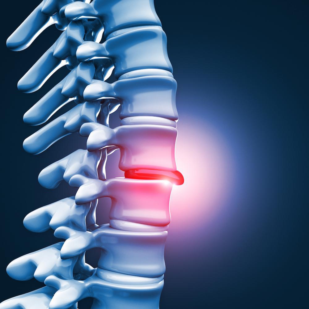 tratamentul discului spinal cum să scapi de durerile de spate și de coloană vertebrală